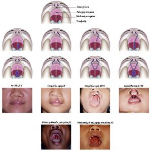 Τύποι Σχιστίας
